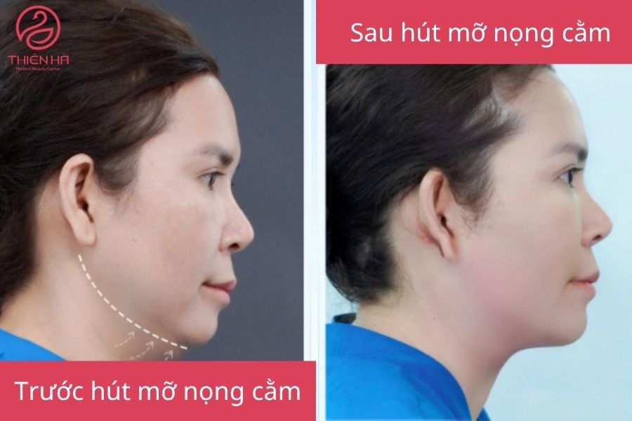 Kết quả hút mỡ nọng cằm 