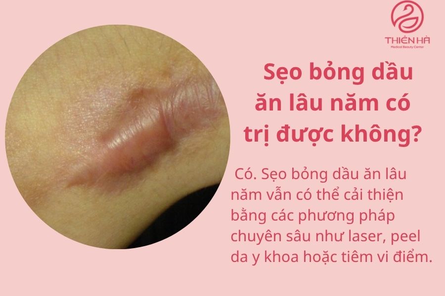 Sẹo bỏng dầu ăn lâu năm có trị được không ? 