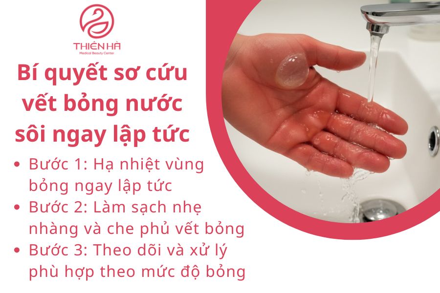 Bí quyết sơ cứu vết bỏng nước sôi ngay lập tức để hạn chế sẹo tối đa