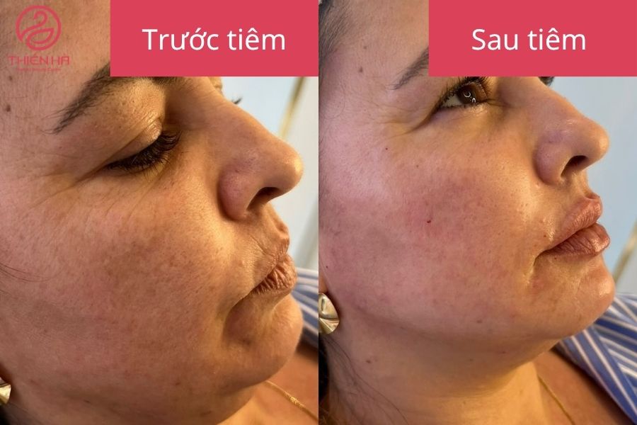 Kết quả sau tiêm vùng điều trị thon gọn 