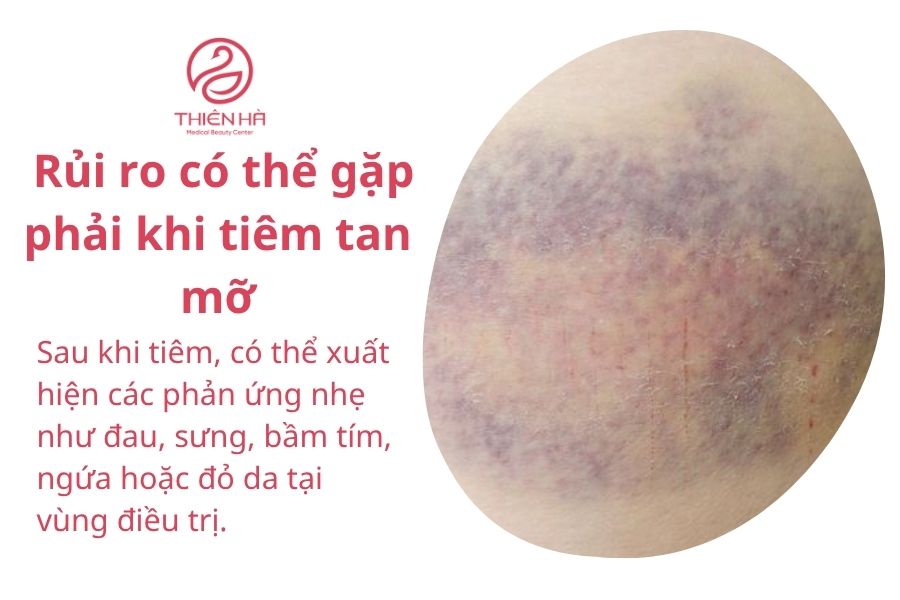 Rủi ro có thể gặp phải khi tiêm tan mỡ 