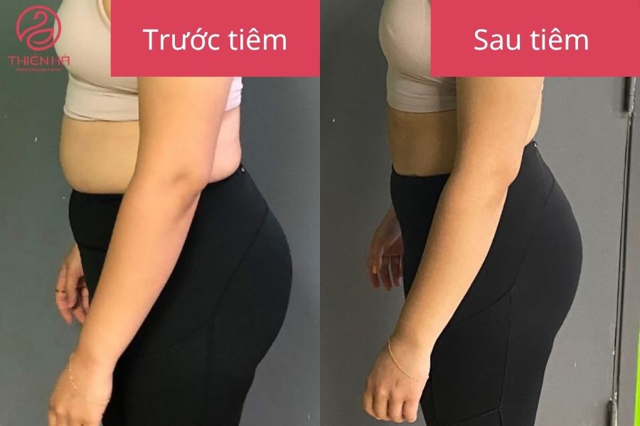 Kết quả sau tiêm tan mỡ bụng 