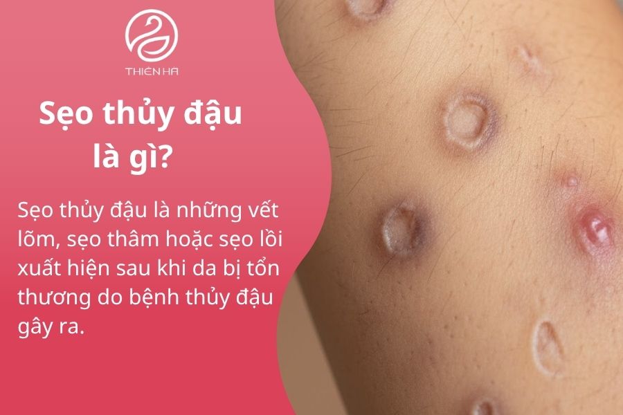 Sẹo thủy đậu là gì?