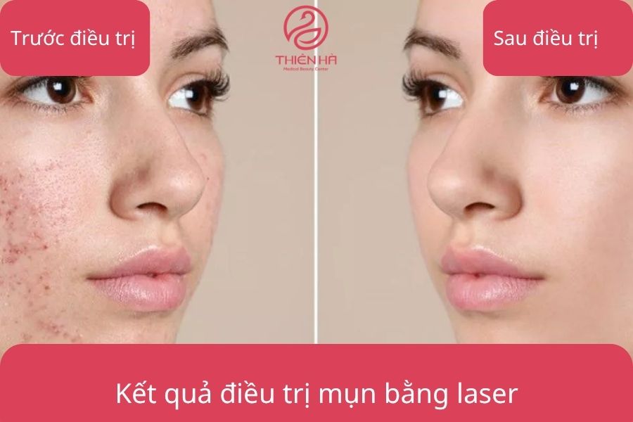 Kết quả điều trị mụn bằng laser