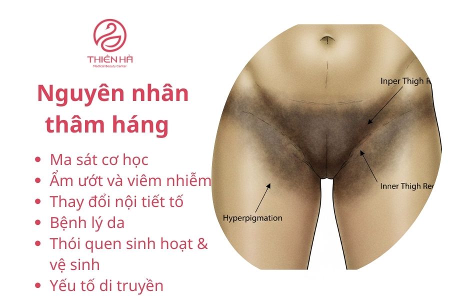 Nguyên nhân thâm háng 