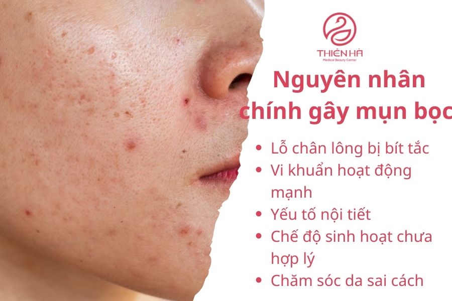 Nguyên nhân chính gây mụn bọc 