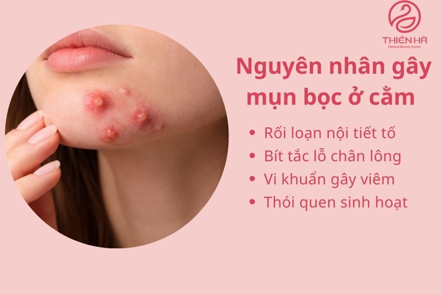 Nguyên nhân gây mụn bọc ở cằm