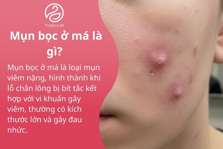 Mụn bọc ở má là gì? Cách nhận biết, điều trị và phòng ngừa tái phát