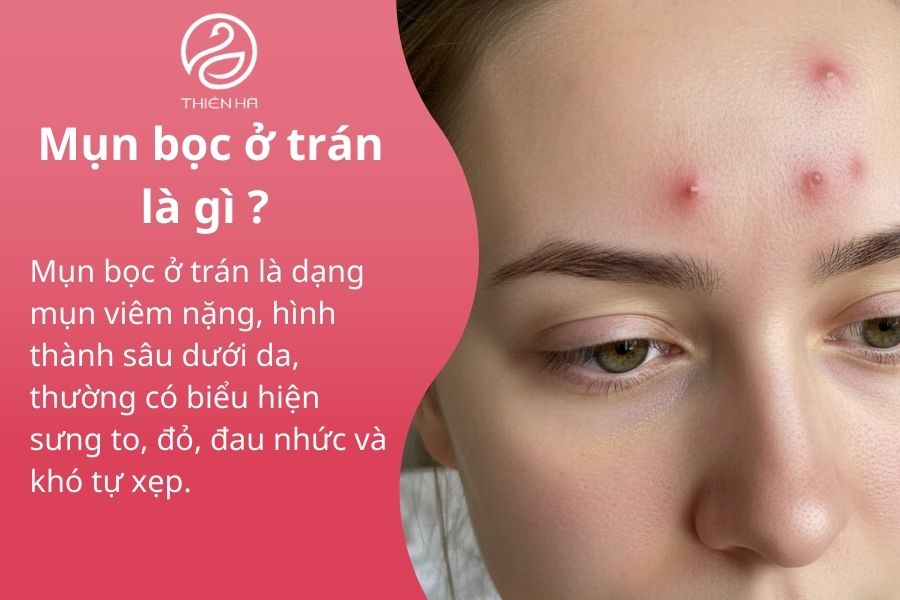 Mụn bọc ở trán: Nguyên nhân, dấu hiệu nguy hiểm và cách điều trị hiệu quả