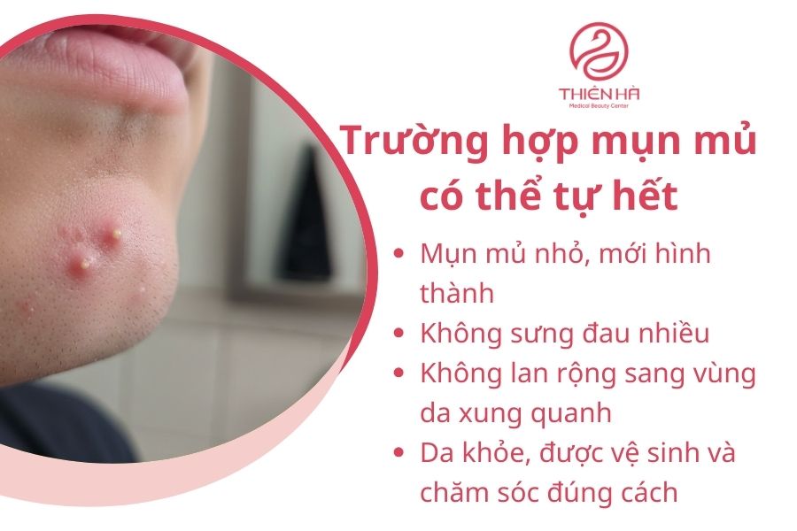 Trường hợp mụn mủ có thể tự hết
