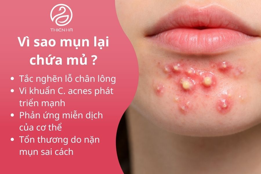 Nguyên nhân mụn chứa mủ 