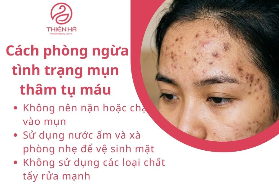 Cách phòng ngừa tình trạng mụn thâm tụ máu