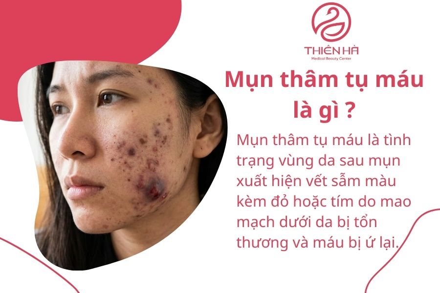 Mụn thâm tụ máu: Nguyên nhân, cách điều trị và lưu ý phòng ngừa tái phát