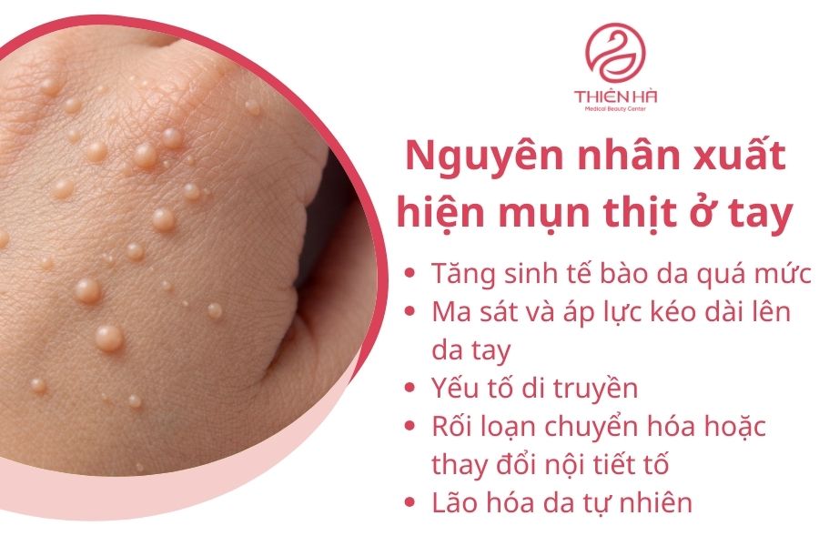 Nguyên nhân xuất hiện mụn thịt ở tay