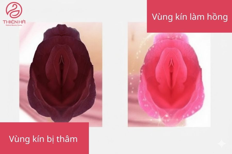 Hình ảnh vùng kín vị thâm đen và vùng kín làm hồng 